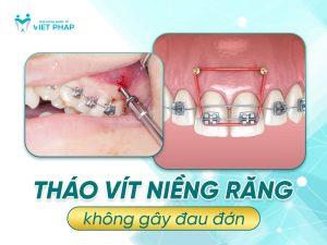 Tháo vít niềng răng có đau không?