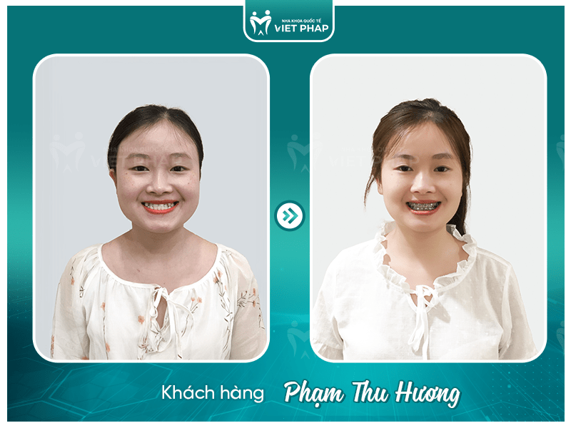20 tuoi nieng rang bao lau Pham Thu Huong Khách hàng Phạm Thu Hương