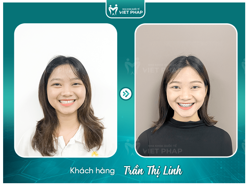20 tuoi nieng rang bao lau Tran Thi Linh Khách hàng Trần Thị Linh