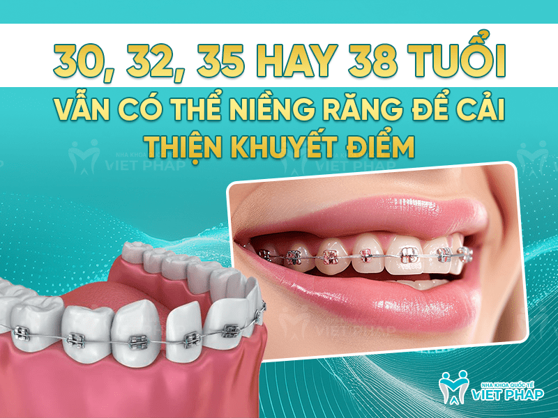 30 tuổi niềng răng mặt bao lâu? Thời gian và hiệu quả niềng răng ở tuổi trưởng thành