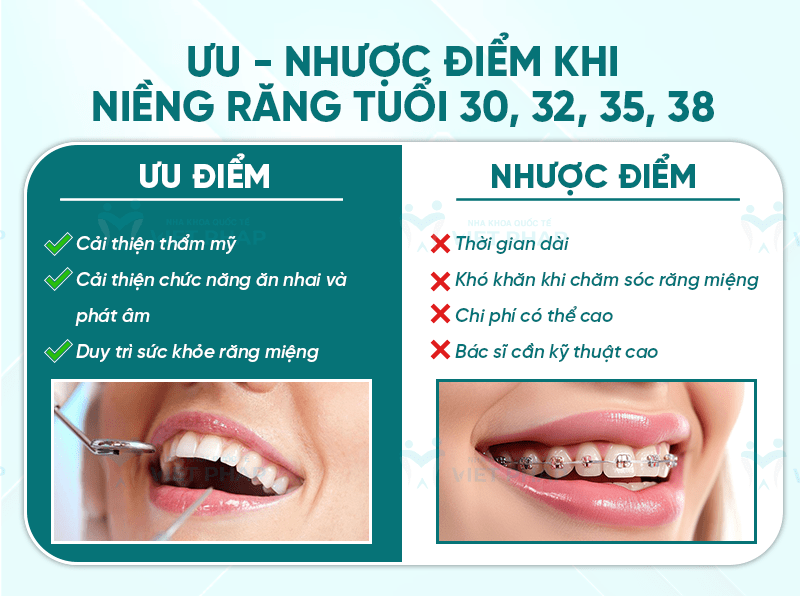 Ưu - nhược điểm khi niềng răng tuổi 30, 32, 35, 38