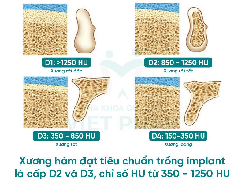 Mức độ xương hàm cần đạt tiêu chuẩn để trồng implant