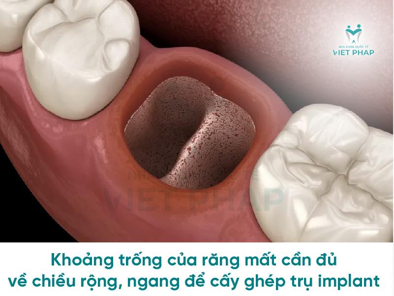Điều kiện về khoảng trống của răng mất