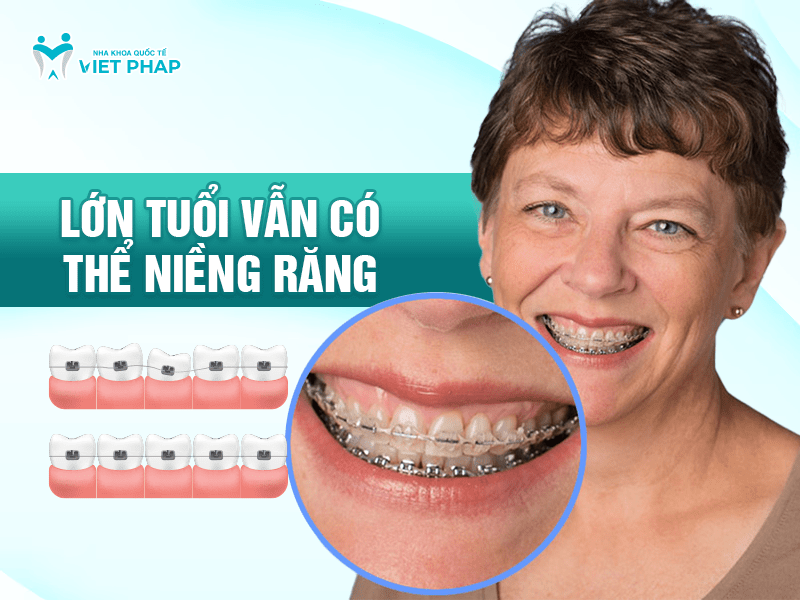 Người lớn tuổi vẫn có thể niềng răng và đạt hiệu quả
