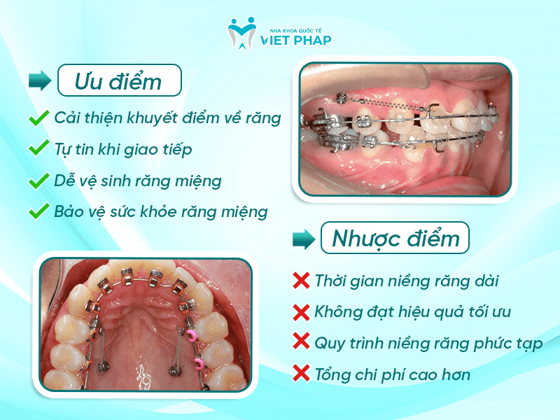 Ưu - nhược điểm khi niềng răng người lớn