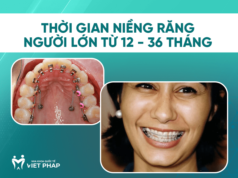 Thời gian niềng răng người lớn khoảng từ 12 - 36 tháng
