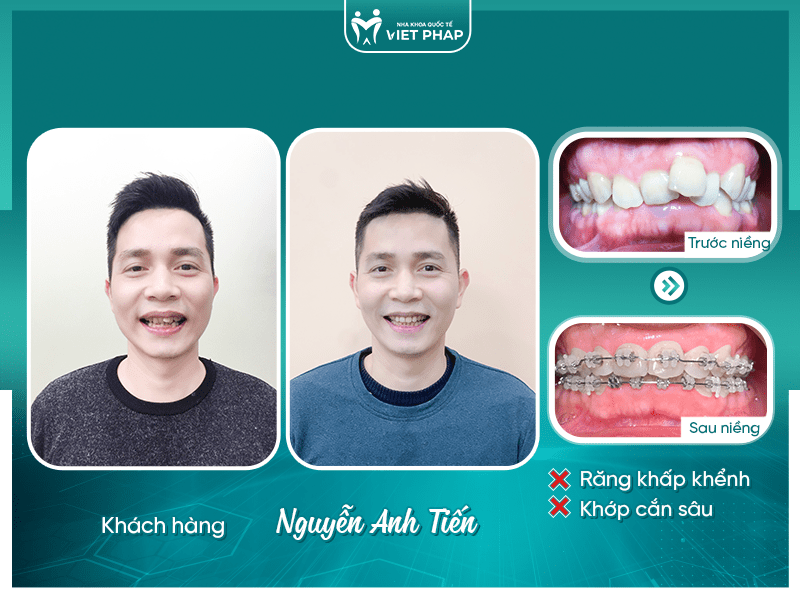 Khách hàng Nguyễn Anh Tiến trước và sau khi niềng răng