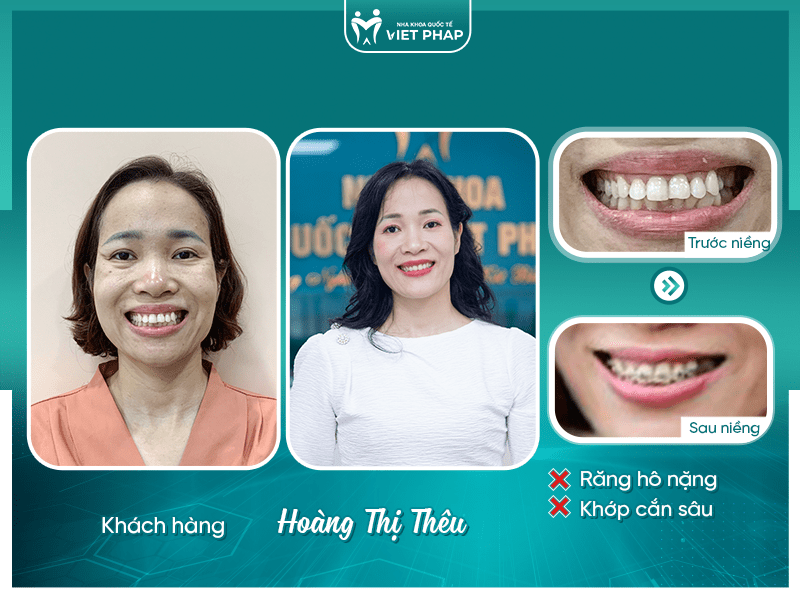 Khách hàng Hoàng Thị Thêu trước và sau khi niềng răng