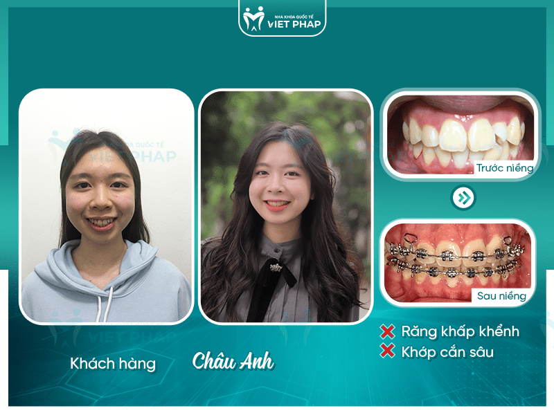 Khách hàng Châu Anh trước và sau khi niềng răng