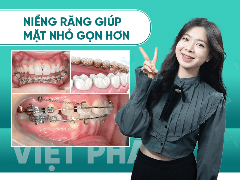 Niềng răng giúp mặt nhỏ gọn hơn
