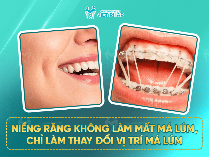 Niềng răng không làm mất má lúm, chỉ làm thay đổi vị trí má lúm