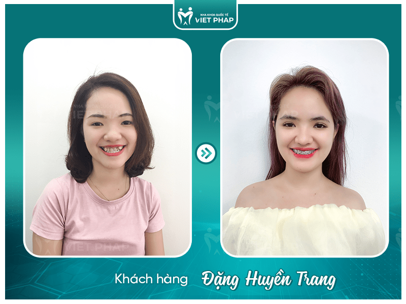 Review nieng rang Tran Huyen Trang Khách hàng Đặng Huyền Trang