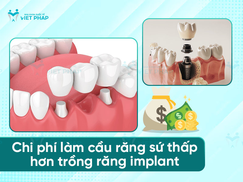 Trong rang gia bao nhieu 4 Chi phí làm cầu răng sứ thấp hơn trồng răng implant