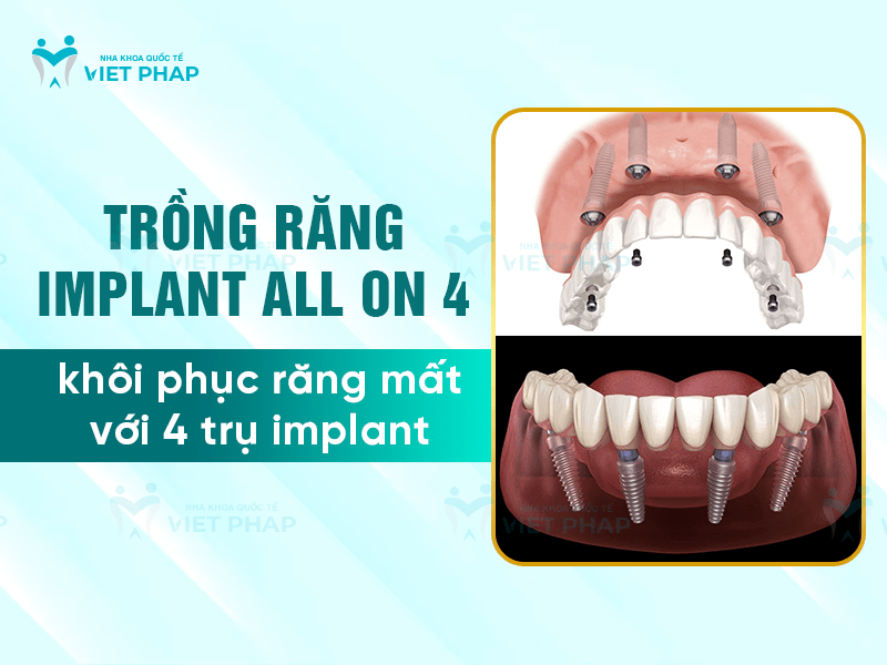 Trồng răng implant All On 4 là gì?