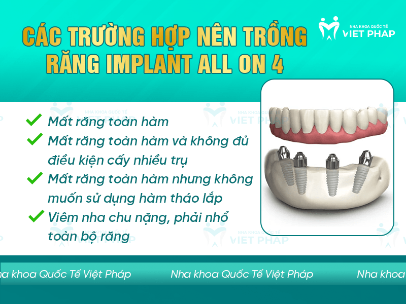Các trường hợp nên trồng răng implant All On 4
