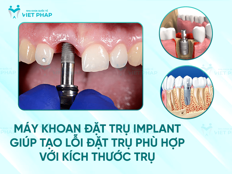 Dung cu cay ghep implant 1 Máy khoan đặt trụ implant giúp tạo lỗi đặt trụ phù hợp với kích thước trụ