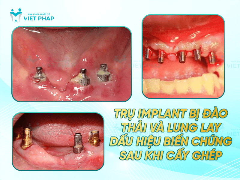 Trụ implant bị đào thải và lung lay - dấu hiệu biến chứng sau khi cấy ghép