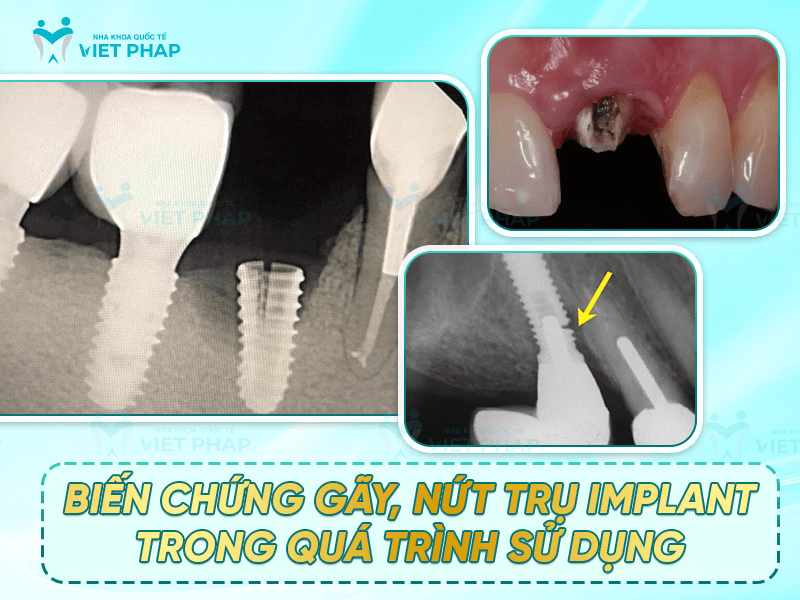 Biến chứng gãy, nứt trụ implant trong quá trình sử dụng