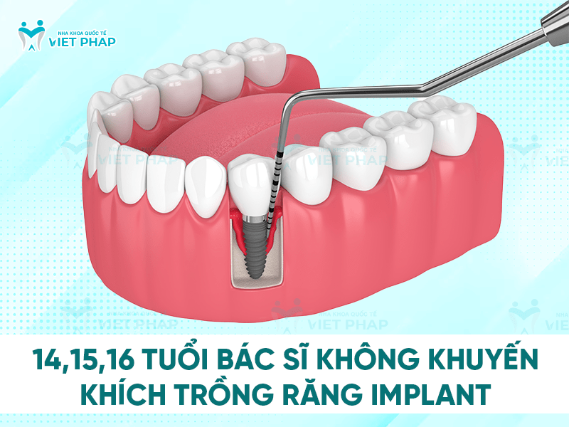 16 tuoi trong rang duoc khong 1 14, 15 và 16 tuổi bác sĩ không khuyến khích trồng răng implant