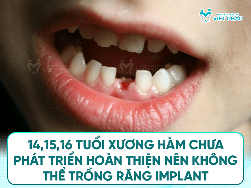 16 tuoi trong rang duoc khong 2 14, 15 và 16 tuổi chưa hàm chưa phát triển hoàn thiện nên không thể trồng răng implant