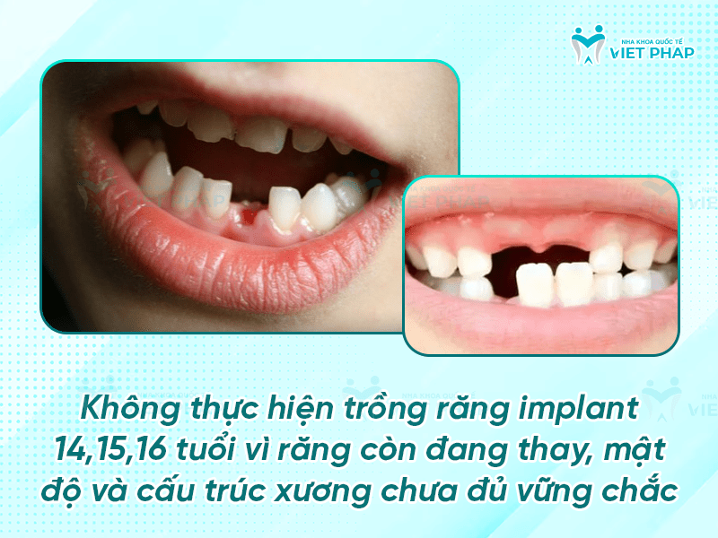 16 tuoi trong rang duoc khong 3 Không thực hiện trồng răng implant cho khách hàng 14,15 và 16 tuổi
