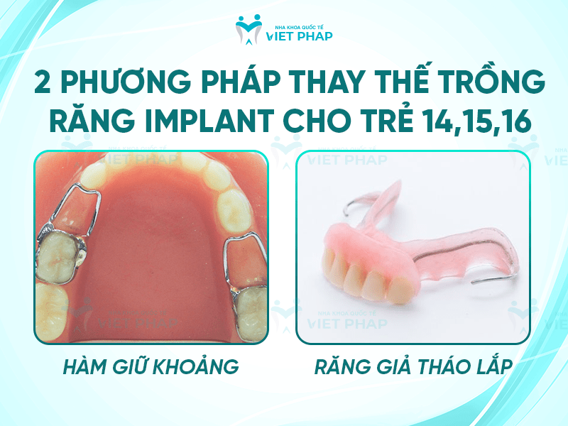 16 tuoi trong rang duoc khong 6 Hai phương pháp thay thế trồng răng implant cho trẻ 14,15,16 tuổi