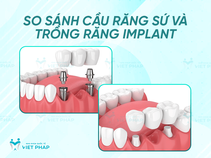Cau rang su 6 So sánh cầu răng sứ và trồng răng implant