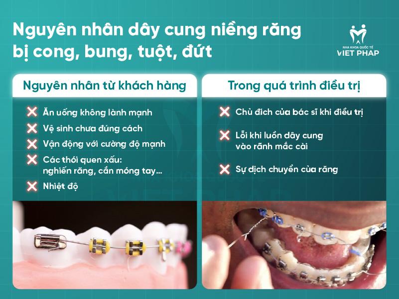 Day cung nieng rang bi cong 2 Nguyên nhân dây cung niềng răng bị cong, bung, tuột, đứt