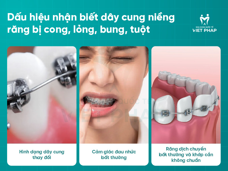 Day cung nieng rang bi cong 4 Dấu hiệu nhận biết dây cung niềng răng bị cong, lỏng, bung, tuột
