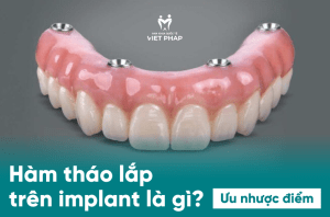 Hàm tháo lắp trên implant là gì ? Ưu nhược điểm