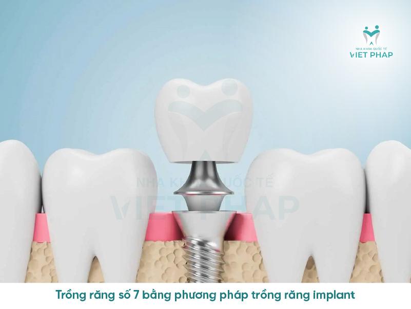 Trồng răng số 7 bằng phương pháp trồng răng implant