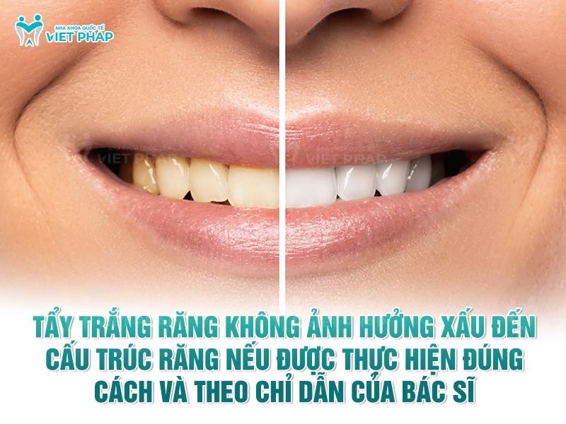 Tay trang rang co lam rang yeu di Nha khoa Quoc Te Viet Phap 1 Tẩy trắng răng không ảnh hưởng xấu đến cấu trúc răng nếu được thực hiện đúng cách và theo chỉ dẫn của bác sĩ