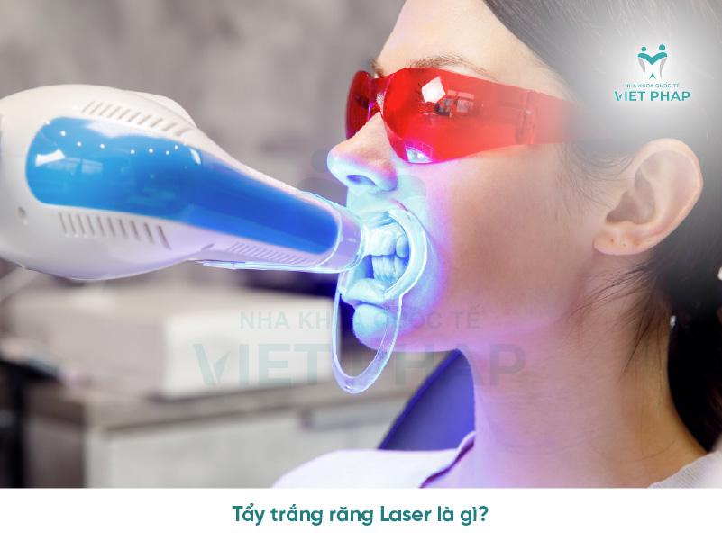 Tẩy trắng răng Laser là gì? 