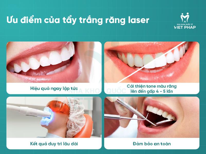 Ưu điểm của tẩy trắng răng Laser