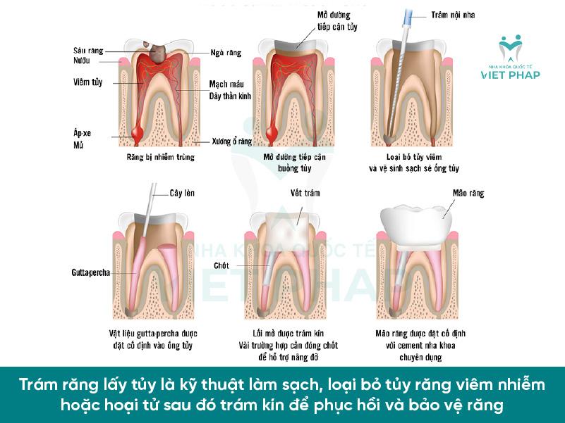 Trám răng lấy tủy là kỹ thuật làm sạch, loại bỏ tủy răng viêm nhiễm hoặc hoại tử sau đó trám kín để phục hồi và bảo vệ răng