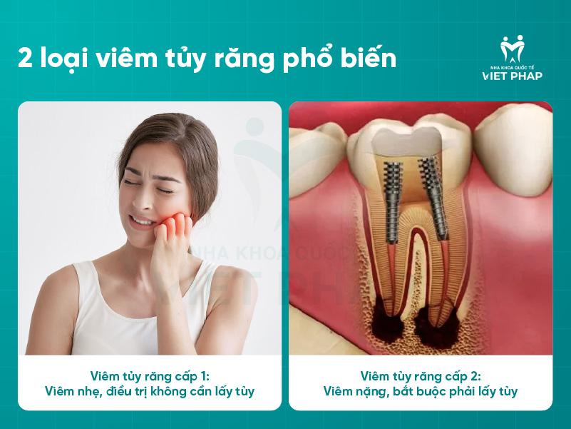 2 loại viêm tủy răng phổ biến