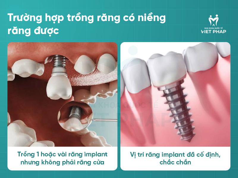 Trong rang co nieng duoc khong Nha khoa Quoc Te Viet Phap 2 Trường hợp trồng răng có niềng răng được