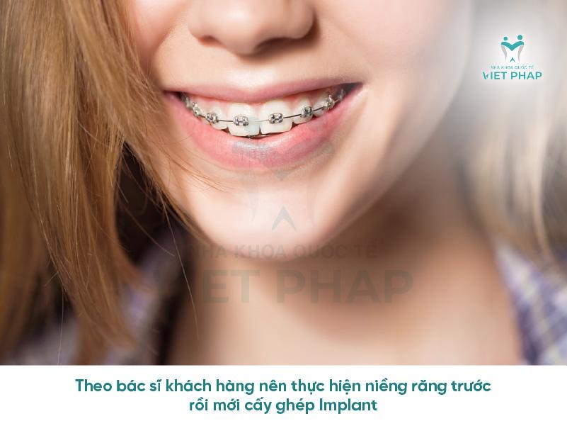 Trong rang co nieng duoc khong Nha khoa Quoc Te Viet Phap 3 Theo bác sĩ khách hàng nên thực hiện niềng răng trước rồi mới cấy ghép Implant