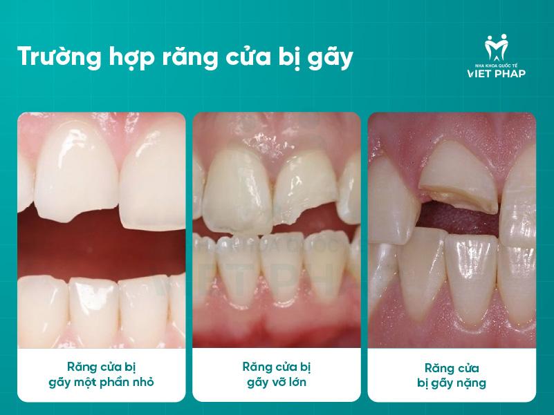 Trường hợp răng cửa bị gãy