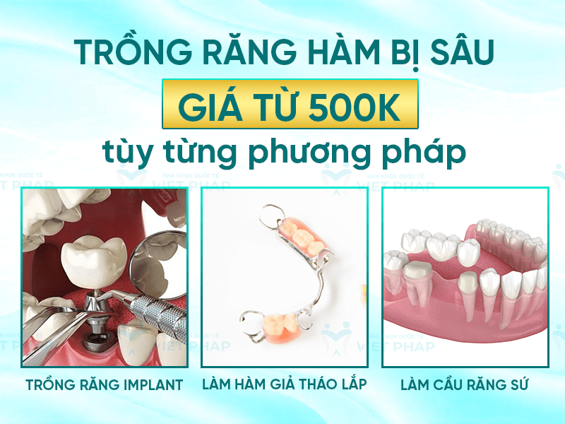 Trong rang ham bi sau gia bao nhieu 1 Trồng răng hàm bị sâu giá thay đổi tùy theo từng phương pháp, thấp nhất là hàm giả tháo lắp từ 500.000 VNĐ/hàm