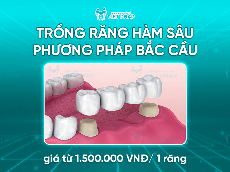 Trong rang ham bi sau gia bao nhieu 3 Trồng răng hàm sâu bằng phương pháp bắc cầu giá từ 1.500.000 VNĐ/răng nếu sử dụng răng sứ kim loại