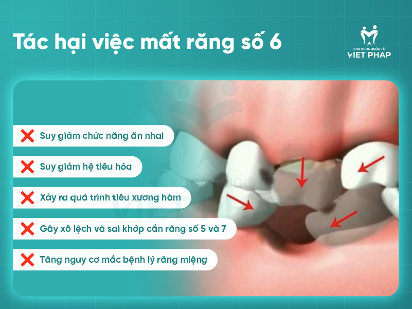 Trong rang so 6 1 Tác hại việc mất răng số 6