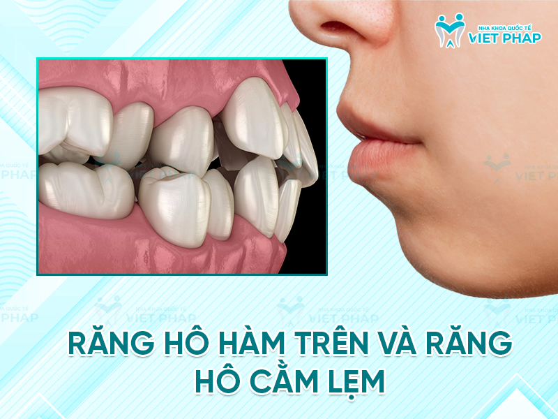 Răng hô hàm trên và răng hô cằm lẹm
