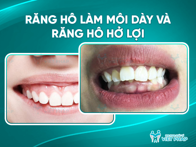 Răng hô làm môi dày và răng hô hở lợi