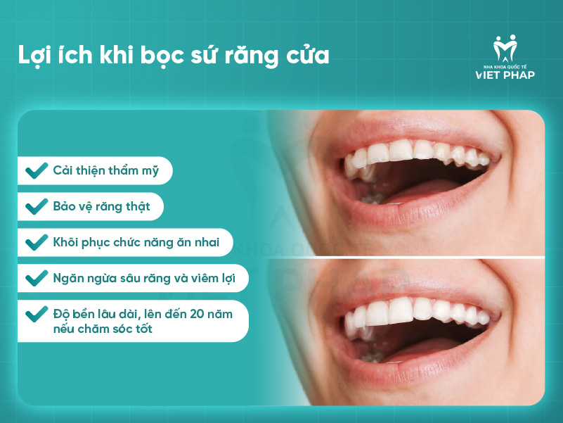 boc su rang cua 5 Lợi ích khi bọc sứ răng cửa