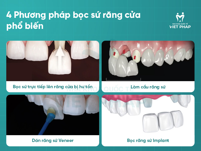 boc su rang cua 6 4 Phương pháp bọc sứ răng cửa