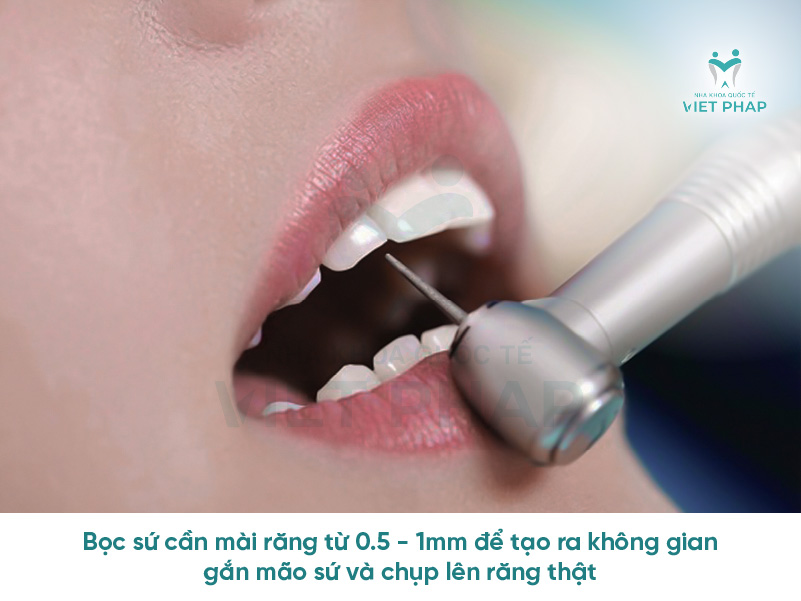 mai rang su 1 Bọc sứa cần mài răng từ 0,5 - 1mm