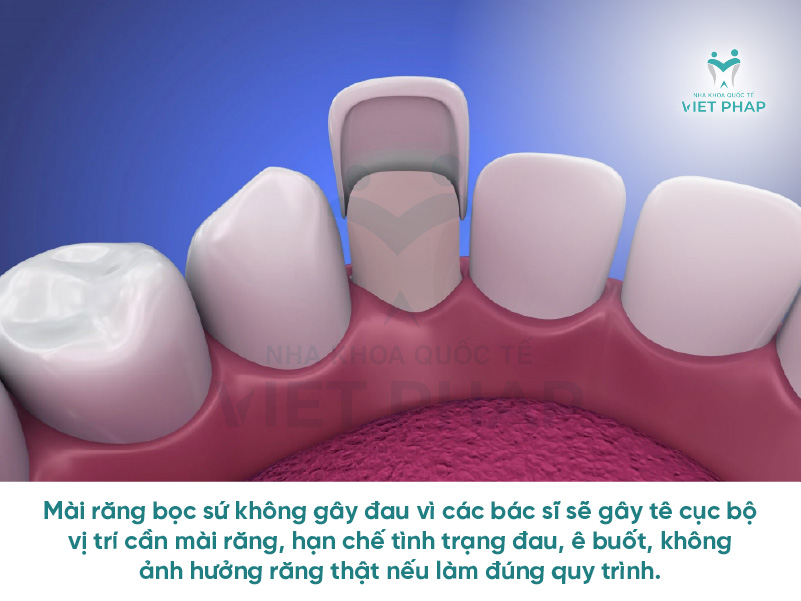 mai rang su 2 Mài răng bọc sứ sẽ không gây đau vì được bác sĩ gây tê cục bộ