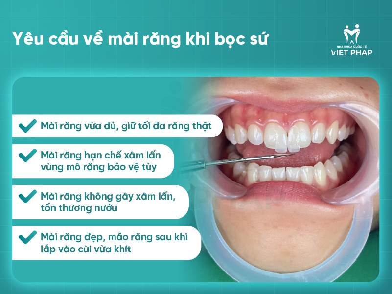 mai rang su 3 Yêu cầu về mài răng khi bọc sứ