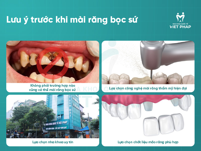 mai rang su 5 Lưu ý trước khi mài răng bọc sứ